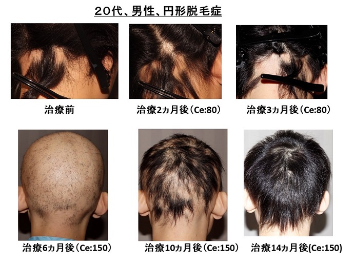 円形脱毛症　病院